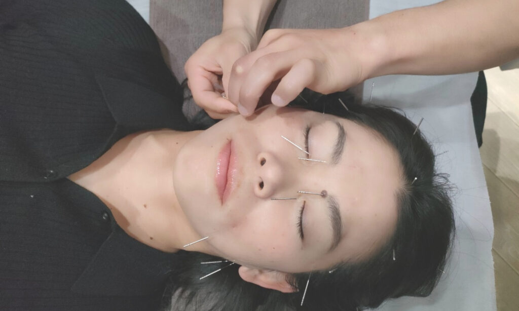 美容鍼